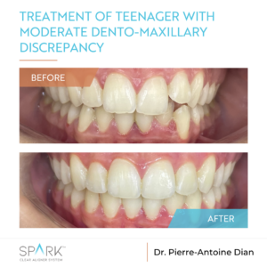 Before and After Spark Clear Aligners