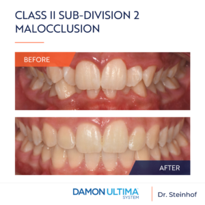 Teeth Before and After Damon Ultima